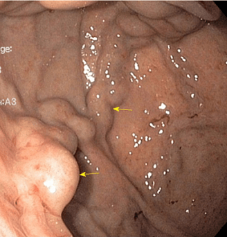 Варикозное расширение вен желудка. Атлас эндоскопических изображений endoatlas